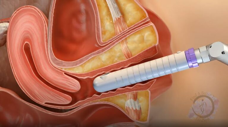 A animation of how the C02re Intima Vaginal Rejuvenation Works